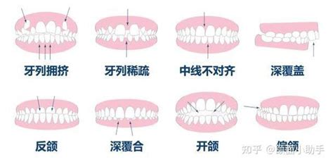 上排牙齒蓋住下排牙齒|牙齒咬合重要嗎？原來上下排牙齒咬合沒那麼簡單